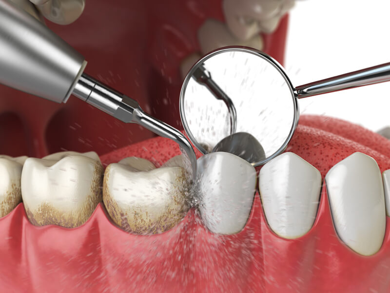 راهنمای استفاده از دستگاه جرم گیر دندان خانگی | روش از بین بردن جرم دندان
