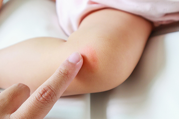 skin allergies in children